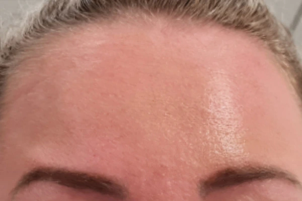 korekcija-bora-posle-intervencije