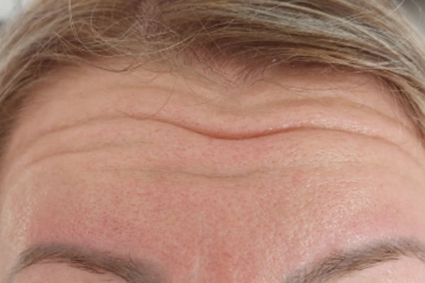 korekcija-bora-prije-intervencije