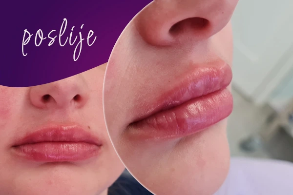 korekcija-usana-poslije-intervencije