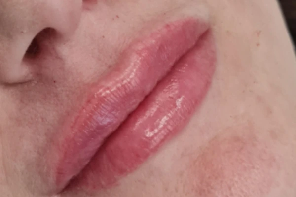 korekcija-usana-poslije-intervencije1