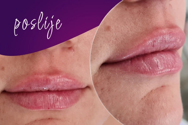 korekcija-usana-poslije-intervencije2