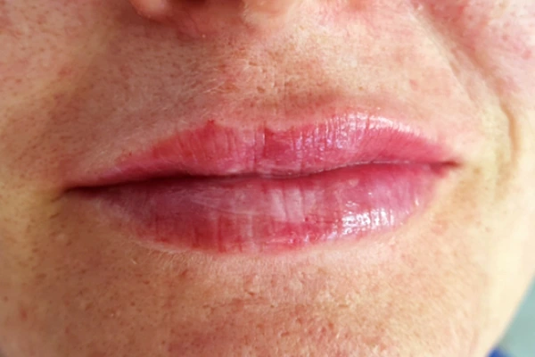 korekcija-usana-poslije-intervencije3