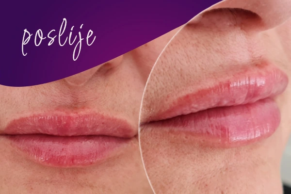 korekcija-usana-poslije-intervencije5