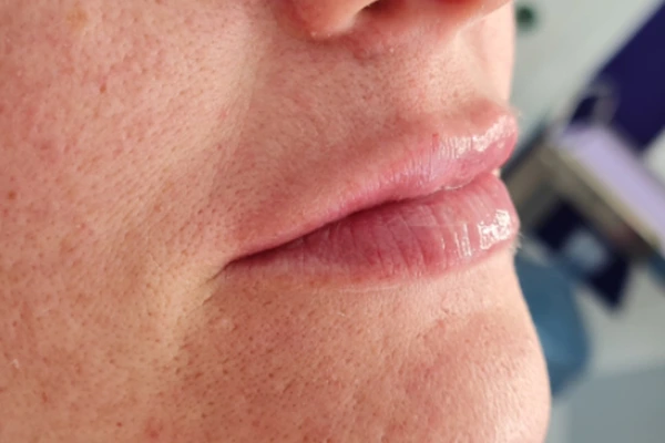 korekcija-usana-poslije-intervencije6