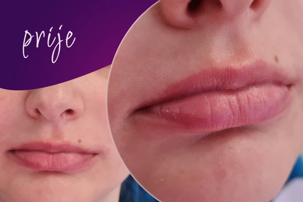 korekcija-usana-prije-intervencije