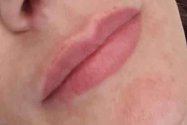 korekcija-usana-prije-intervencije1