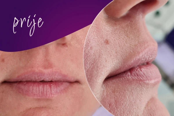 korekcija-usana-prije-intervencije2