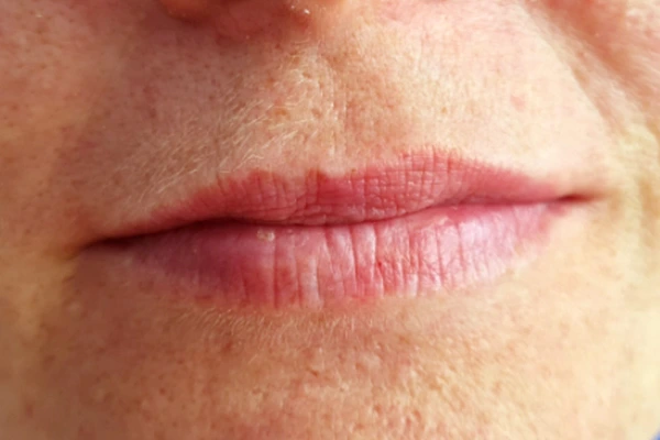 korekcija-usana-prije-intervencije3