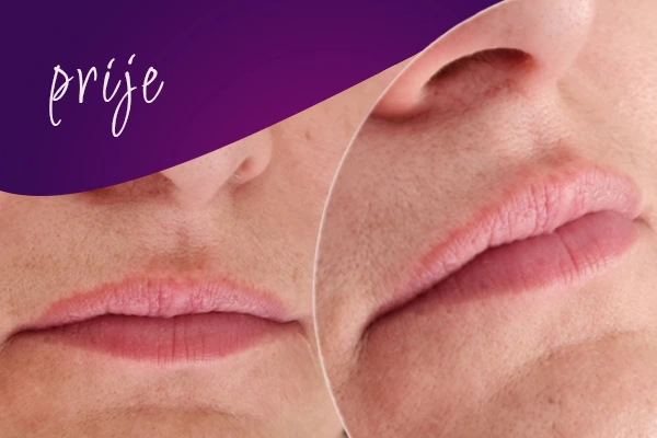 korekcija-usana-prije-intervencije5