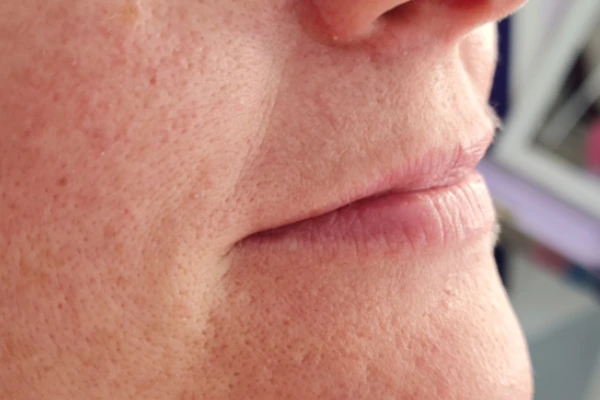 korekcija-usana-prije-intervencije6